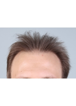 Before Hair Transplant&nbsp;2 Sessions (Areas)